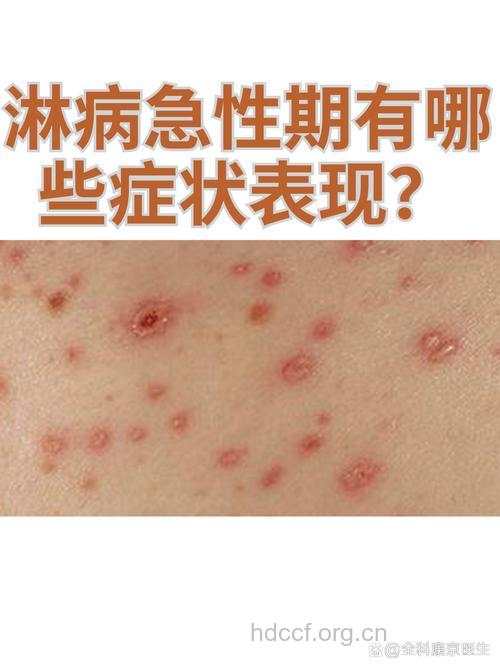 急性淋病的症状表现