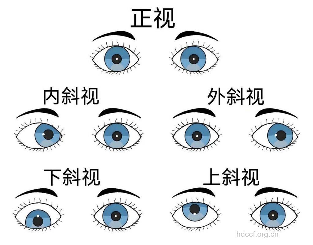 斜视的概念