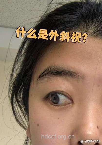 恒定性外斜视与间歇性外斜视有什麽不同？