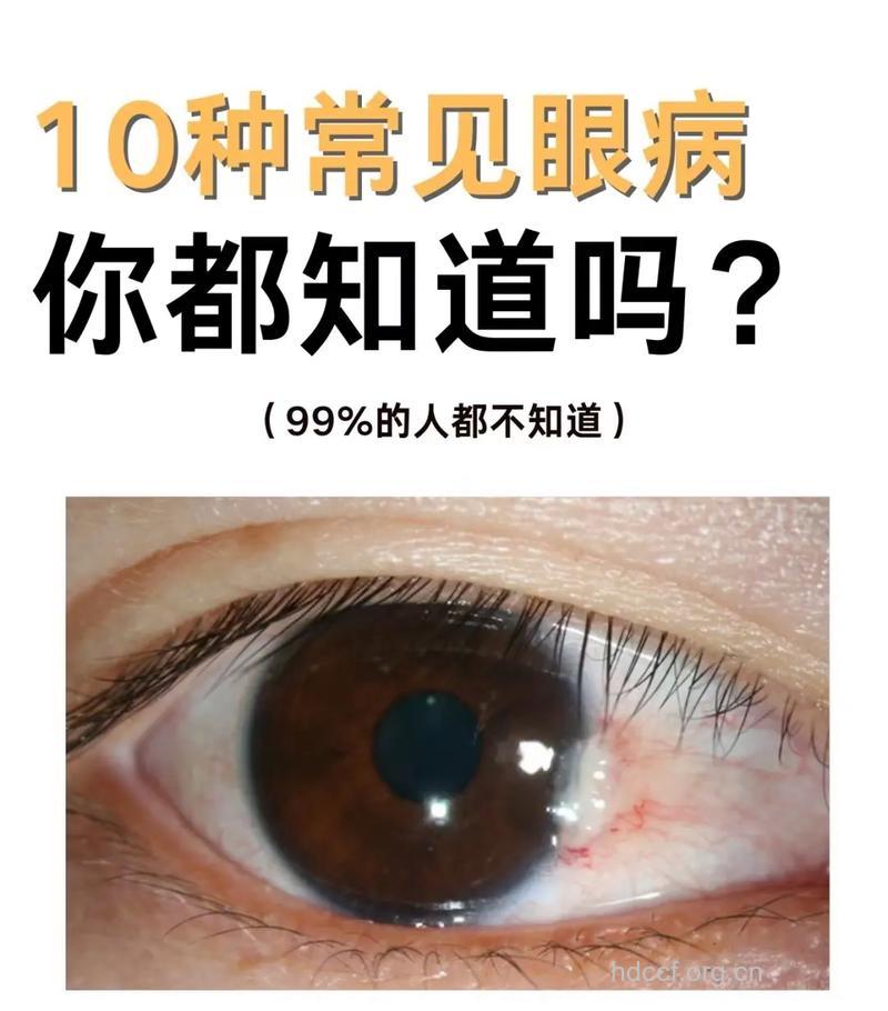 弱视不容易发现的眼病