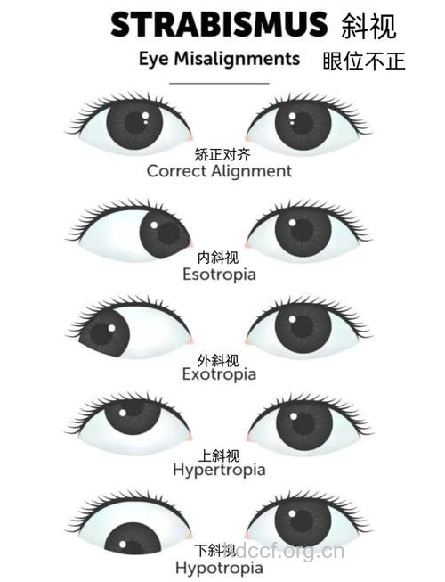斜视有哪几种？