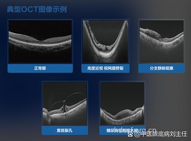 共同性斜视的病理解剖学研究进展