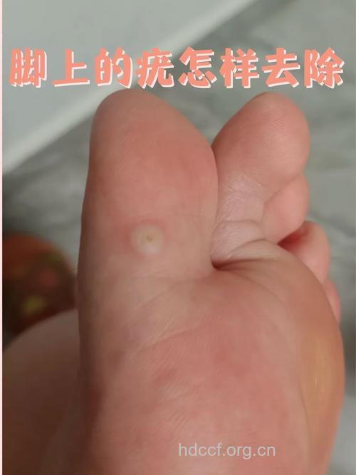 做足疗竟可患上尖锐湿疣？