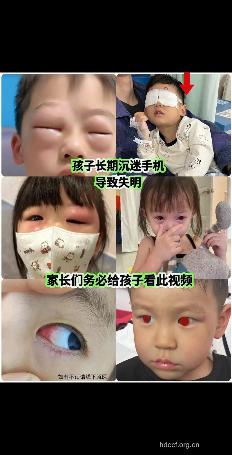 孩子患眼病 治疗莫失机