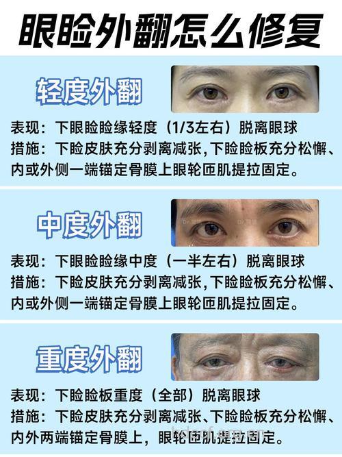 眼睑内翻外翻该怎么办？