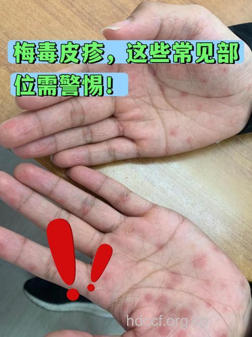 记忆力下降 梅毒在作祟！