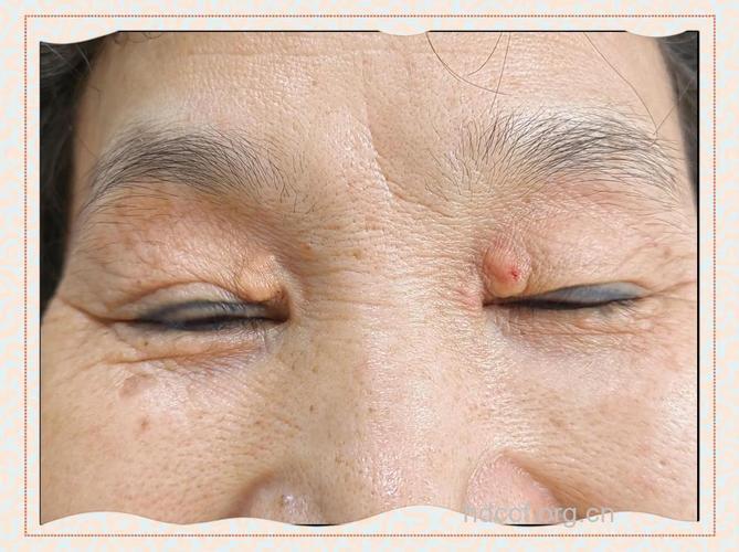 常见的眼睑恶性肿瘤有哪些