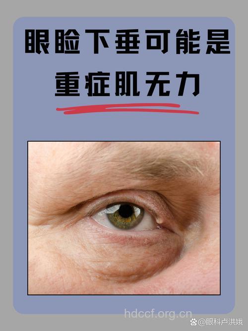 眼睑下垂警惕重症肌无力