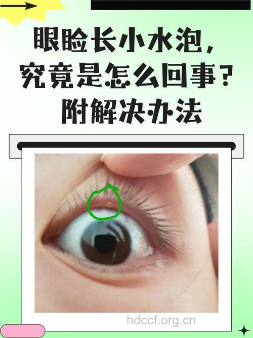 为什么会有“水泡眼”