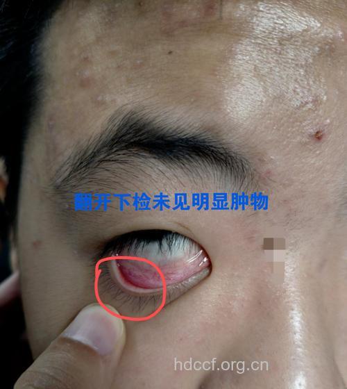 眼科疾病 霰粒肿
