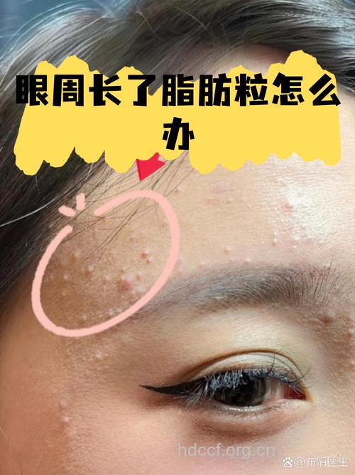 眼周白粒不等于脂肪粒