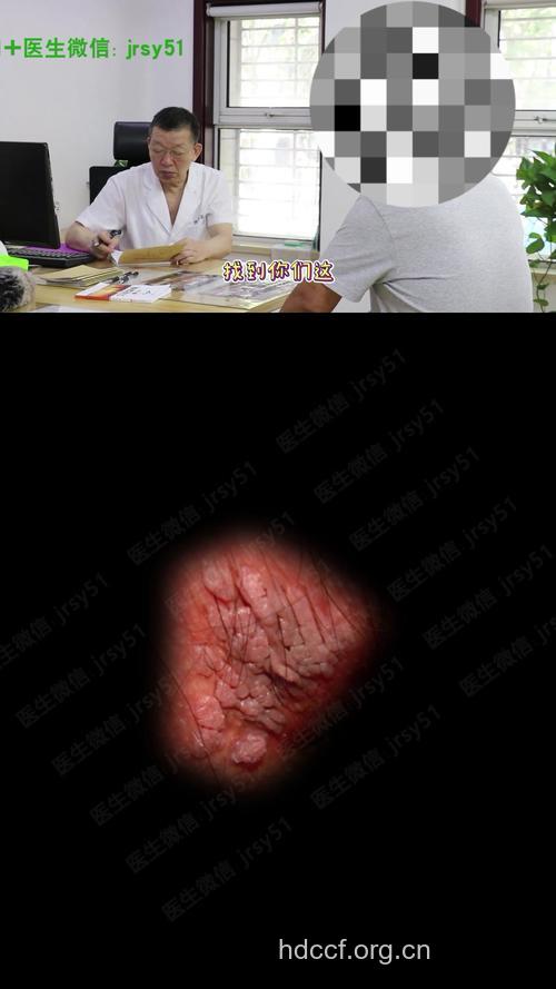 案例:尖锐湿疣感染治疗全过程