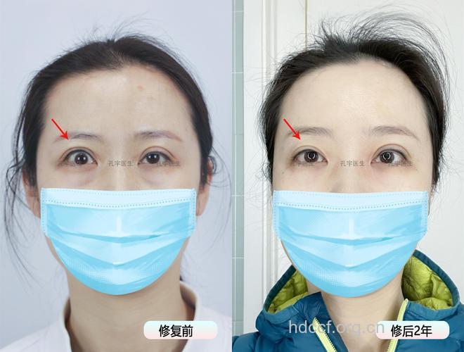 小眼变大眼原来是眼睑退缩