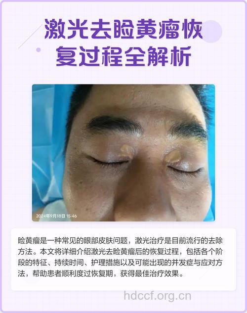 睑黄色瘤手术治疗
