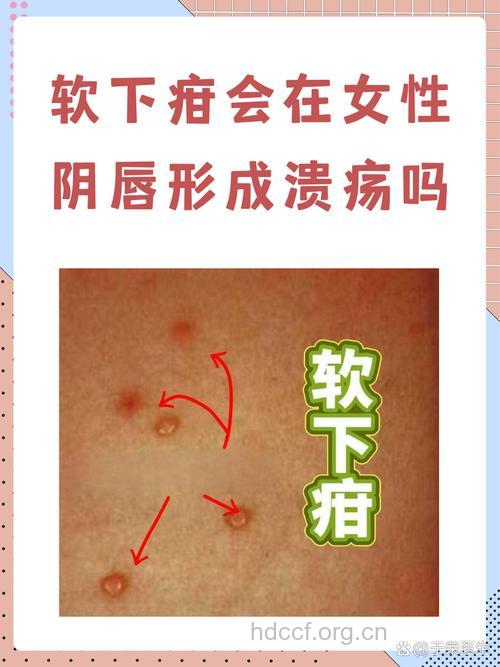 女性常见的性病症状