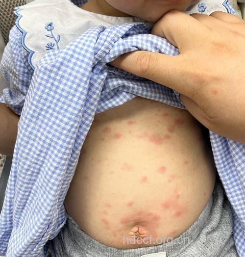 小儿性病症状图片