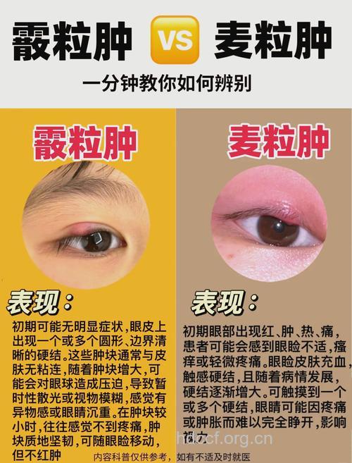 麦粒肿、霰粒肿——夏季易患的两种病