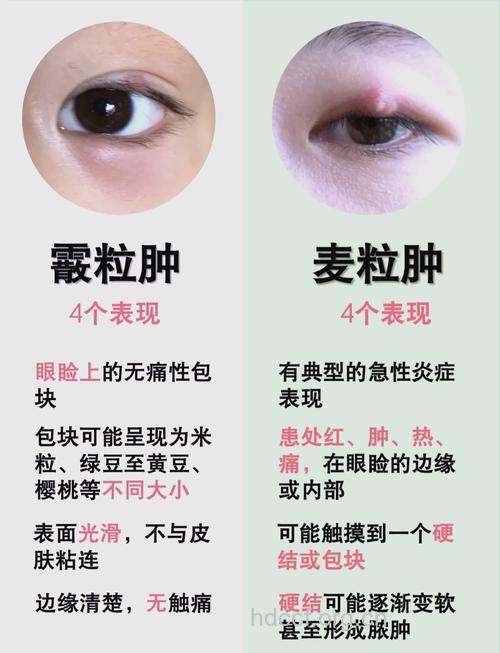 什么是霰粒肿