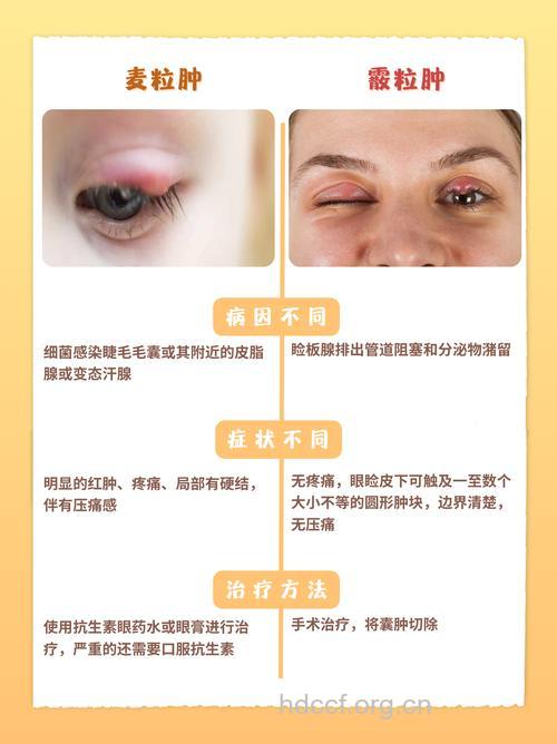 麦粒肿和霰粒肿的鉴别