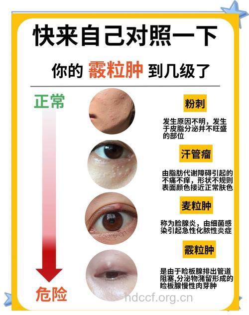 霰粒肿临床表现及治疗