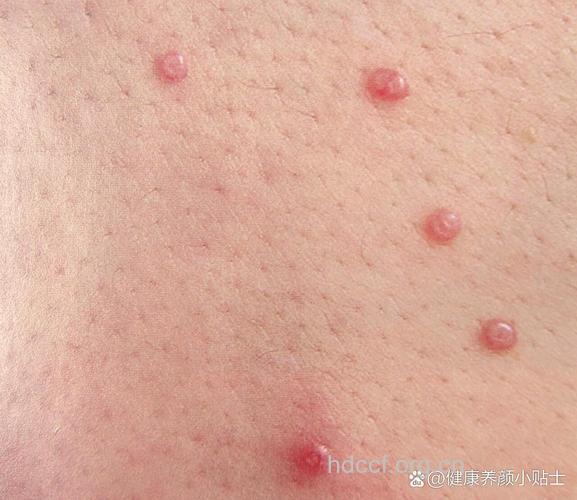 传染性软疣图片集锦