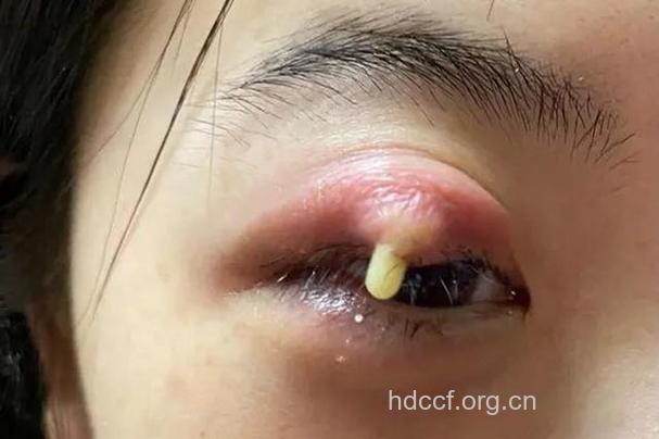 中医里说的“针眼”是什么