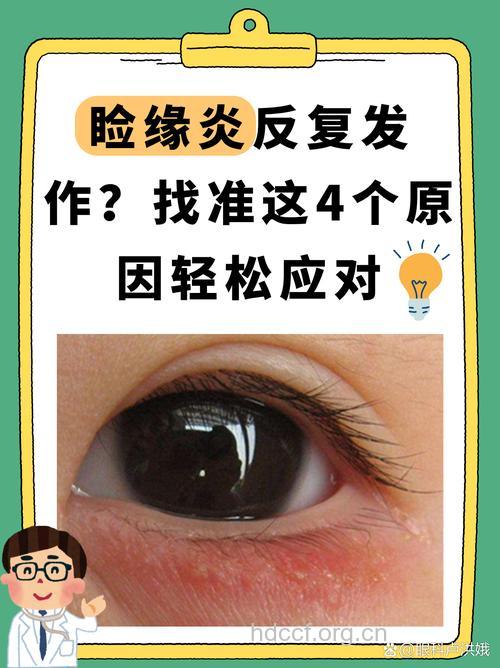 睑缘炎有什么症状