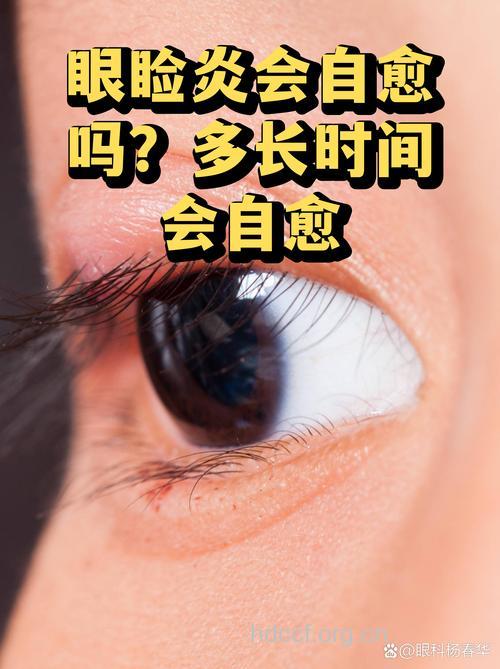 “烂眼边”能治好吗