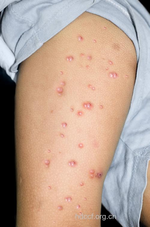 性病的早期症状图片大全