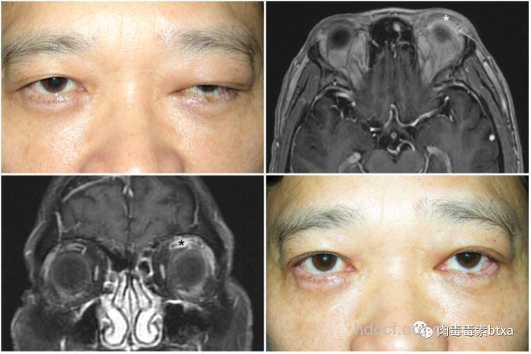 眼眶假瘤的临床表现