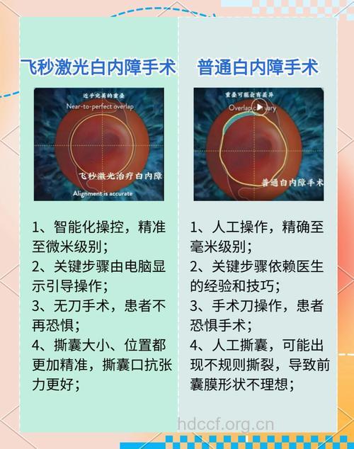 激光切除白内障可能更安全有效