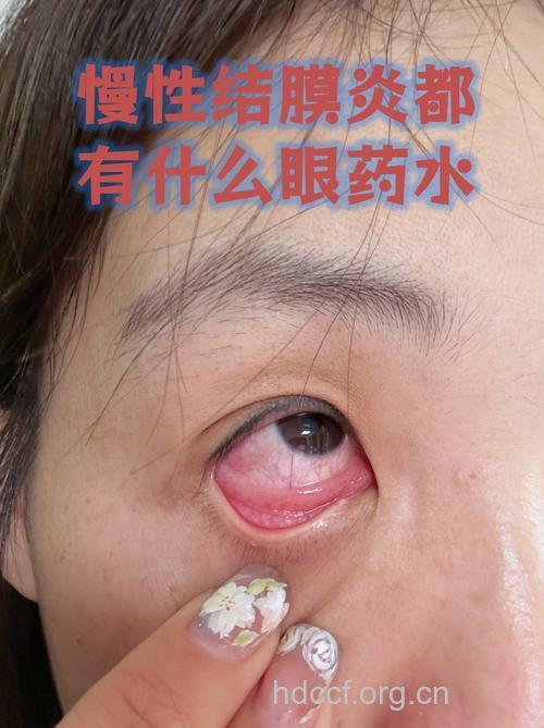 慢性结膜炎的表现有哪些