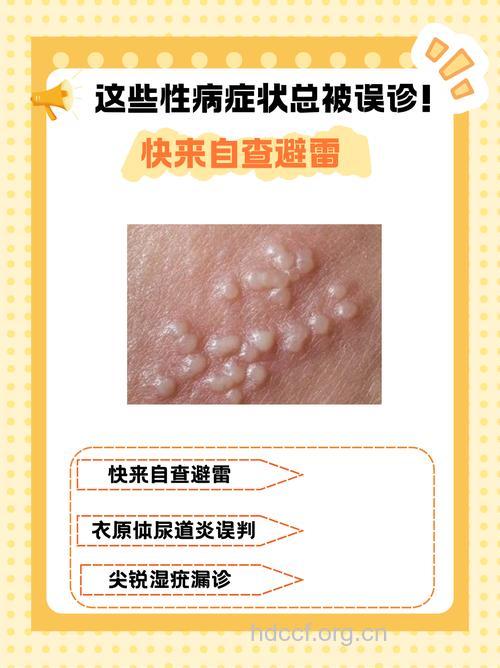 五个性病最常见的症状表现