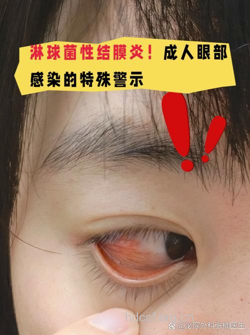 别让眼太累 小心结膜炎