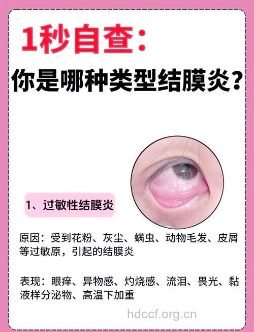 结膜炎你知多少