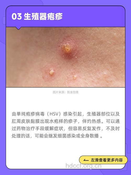 性病的症状有哪些 会影响到生殖器官吗