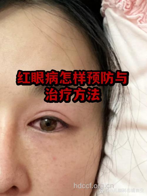 公用键盘 传播红眼病凶手