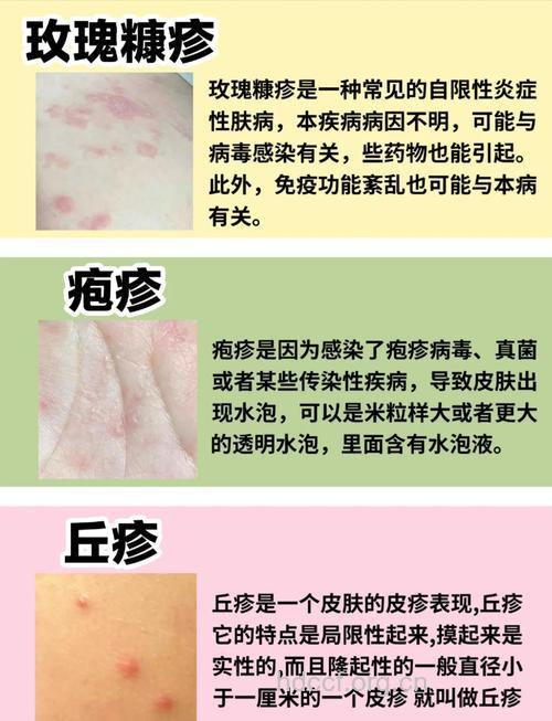 各种性病有什么症状 患性病如何护理