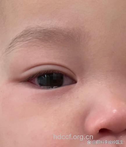 宝贝 可爱大眼睛或藏病