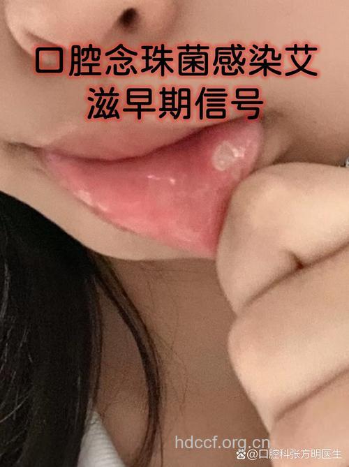 揭从口腔看患性病信号