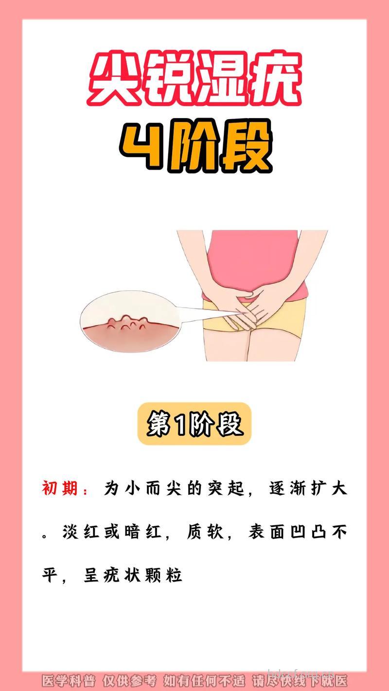 女性尖锐湿疣患者私处护理