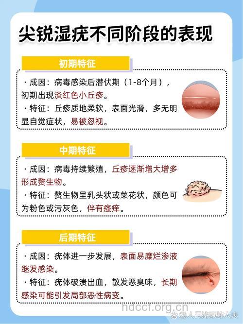 尖锐湿疣的病因以及危害