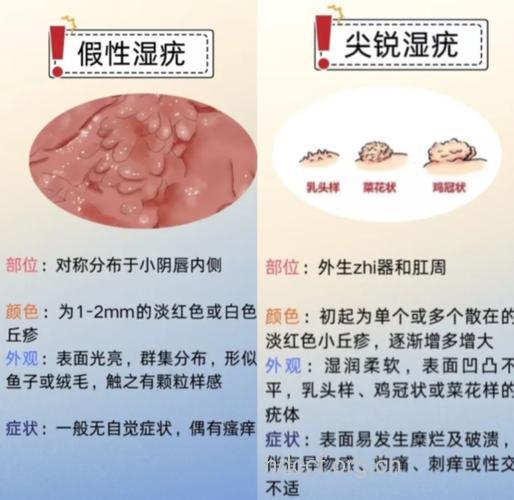 拆穿尖锐湿疣的最大“谎言”
