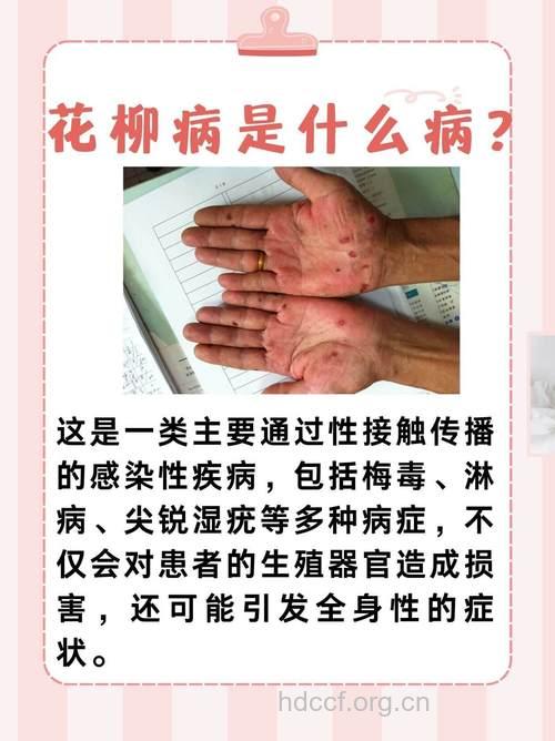 从“花柳病”到性病