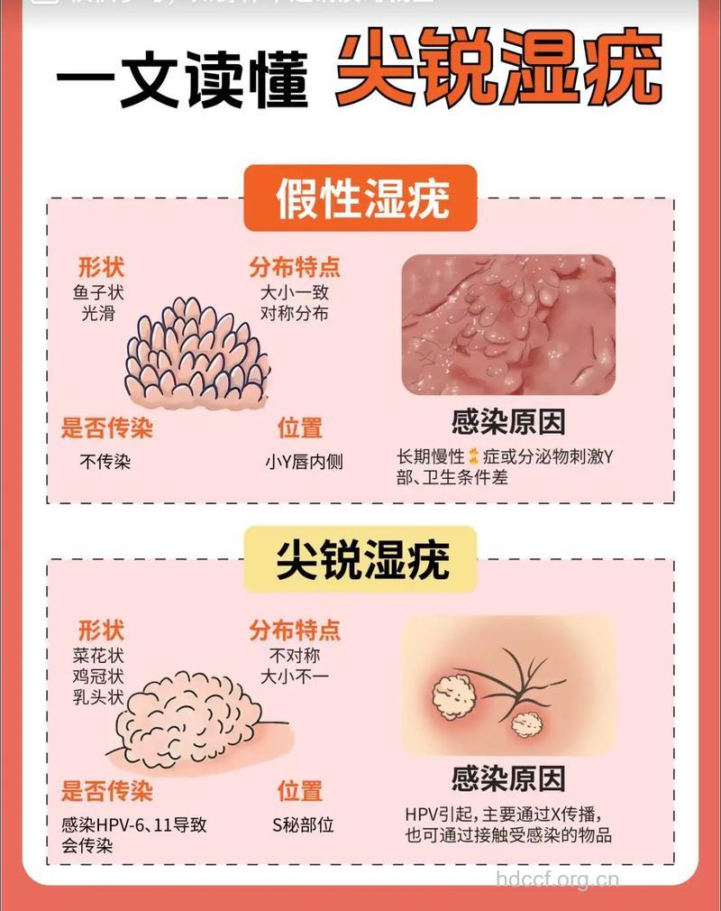 如何鉴别真假尖锐湿疣 潜伏期有多长