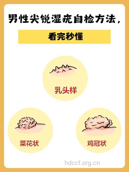 推荐五种检查尖锐湿疣的方法