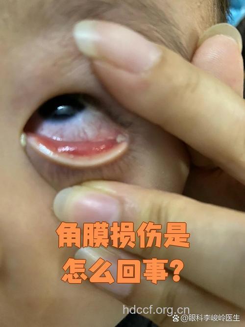 角膜擦伤后有哪些症状