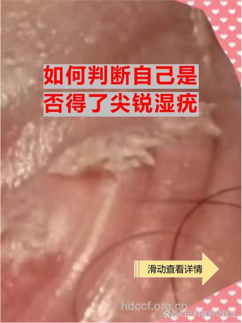揭秘 盐能治尖锐湿疣吗