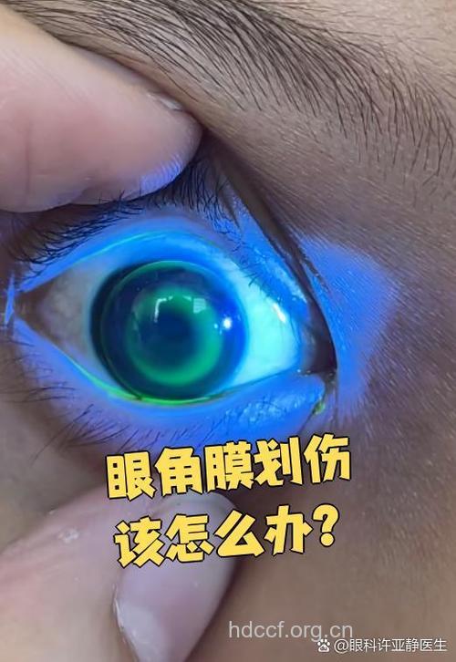 角膜浅擦伤有哪些治疗方法