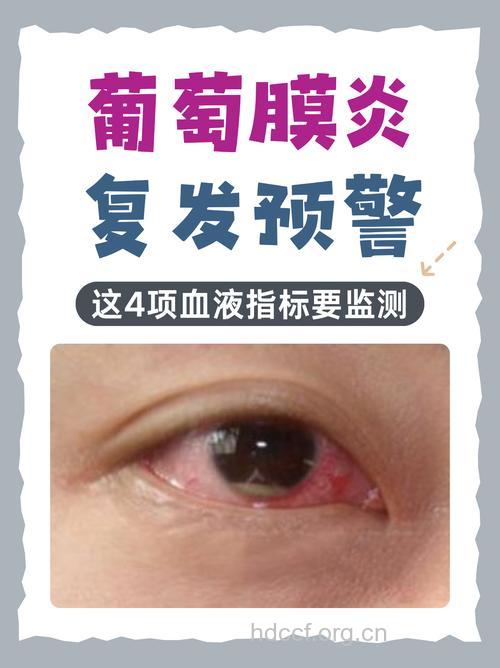 葡萄膜炎有哪些并发症